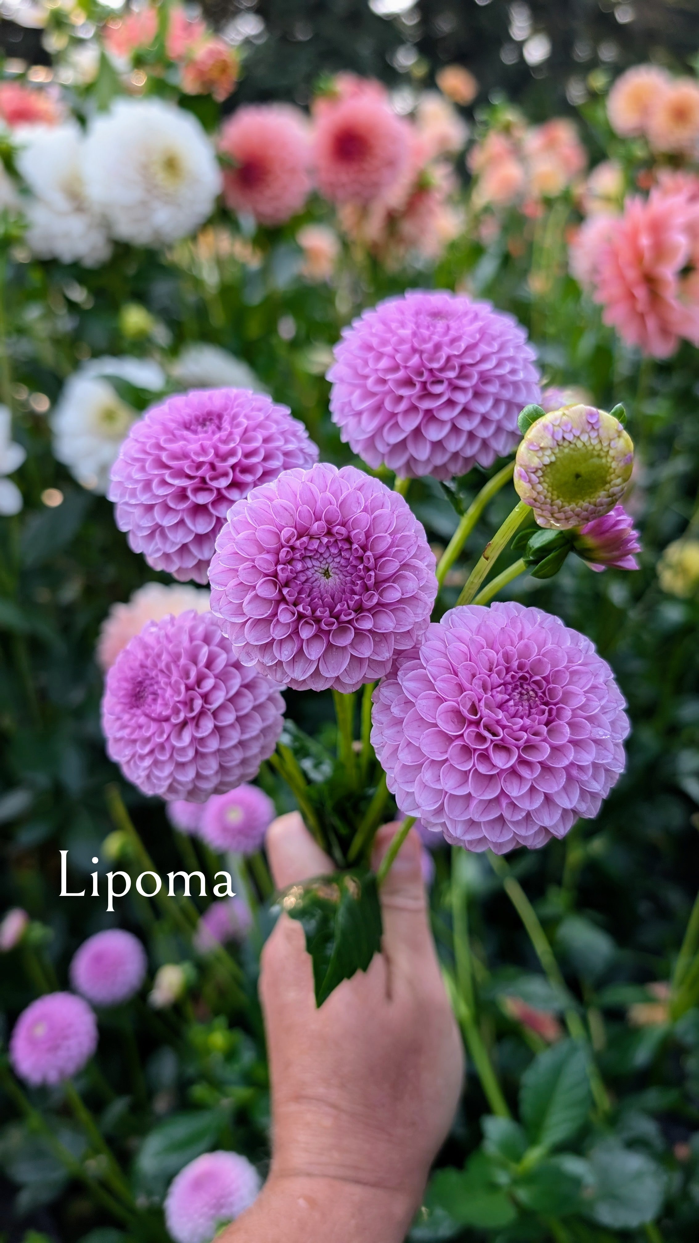 Lipoma